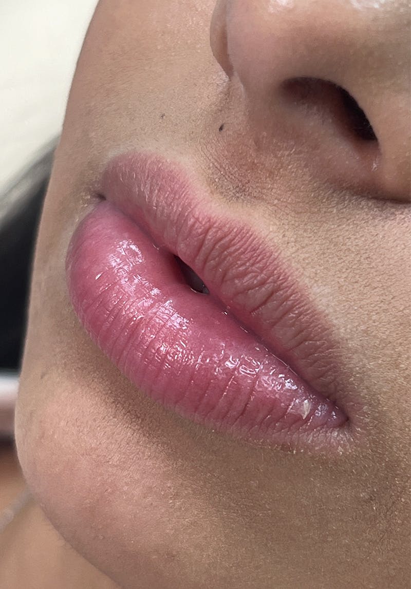 Dermal Fillers Before & After Gallery - Patient 142927783 - Image 1