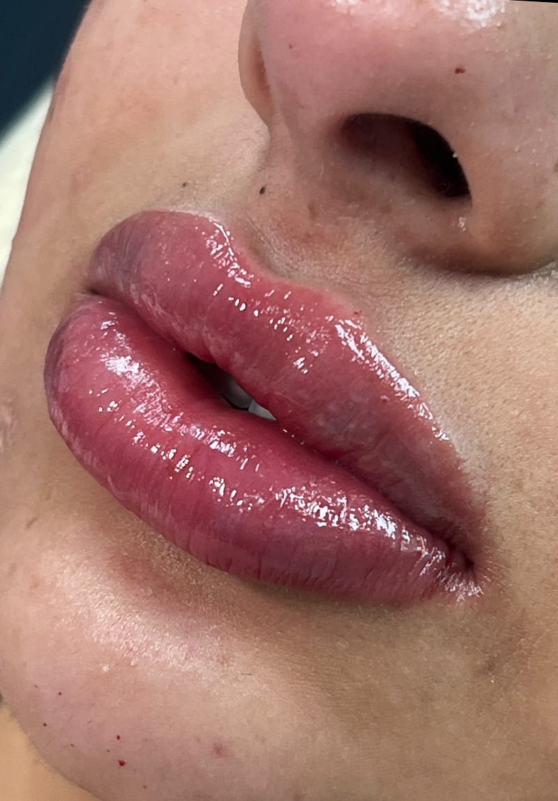 Dermal Fillers Before & After Gallery - Patient 142927783 - Image 2