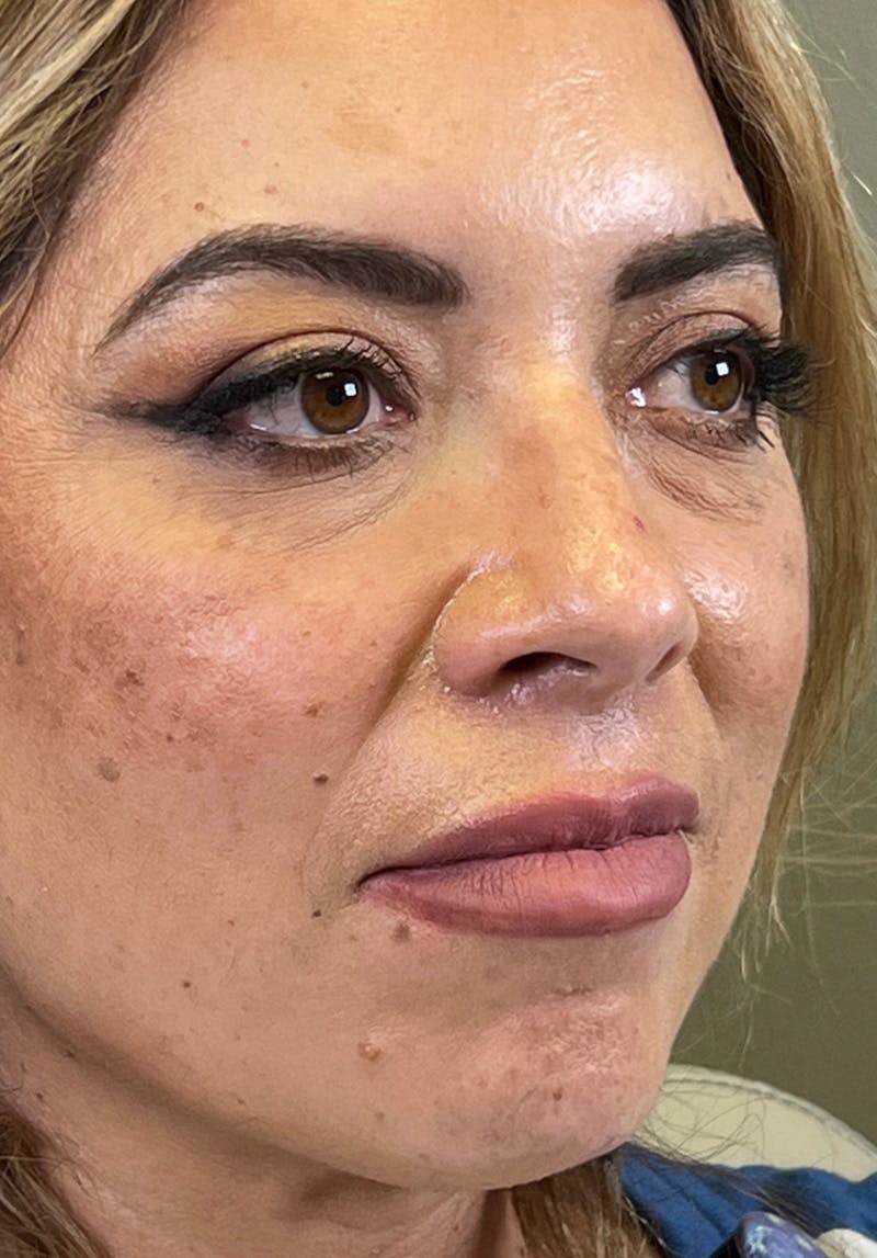 Dermal Fillers Before & After Gallery - Patient 142927782 - Image 1