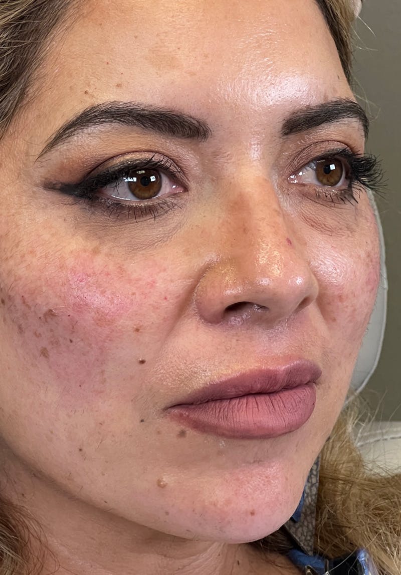 Dermal Fillers Before & After Gallery - Patient 142927782 - Image 2