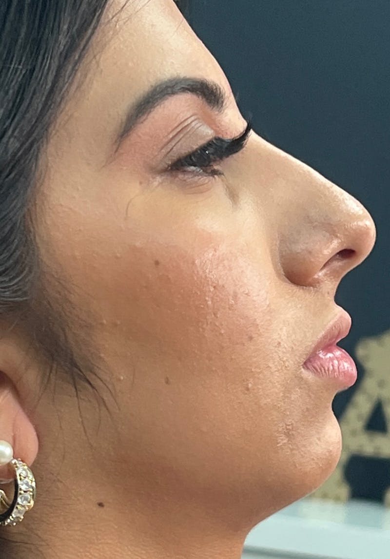 Dermal Fillers Before & After Gallery - Patient 142927781 - Image 1