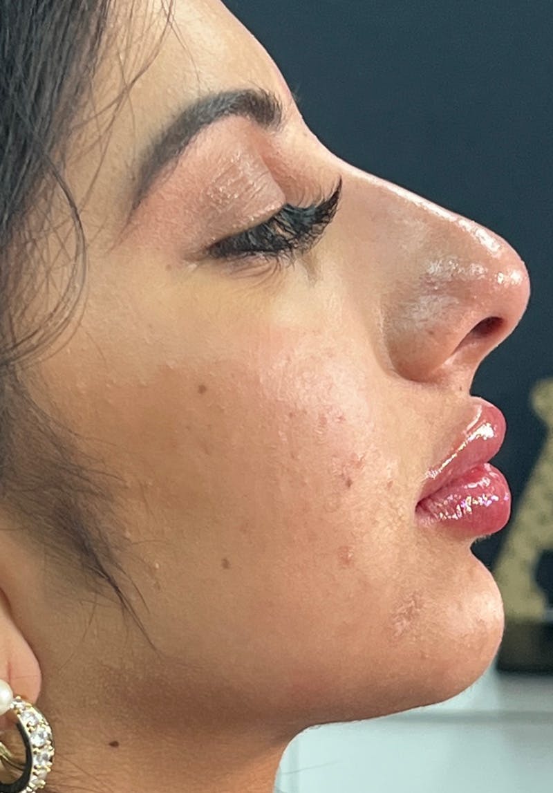 Dermal Fillers Before & After Gallery - Patient 142927781 - Image 2