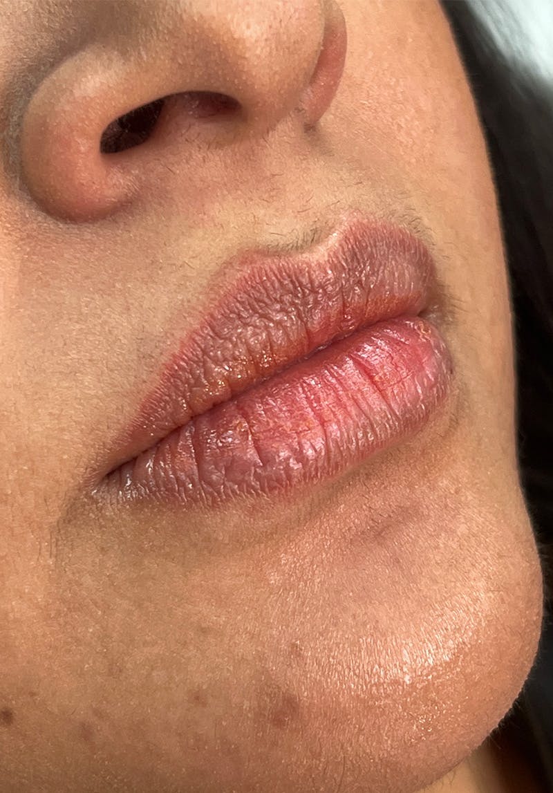 Dermal Fillers Before & After Gallery - Patient 142927780 - Image 1