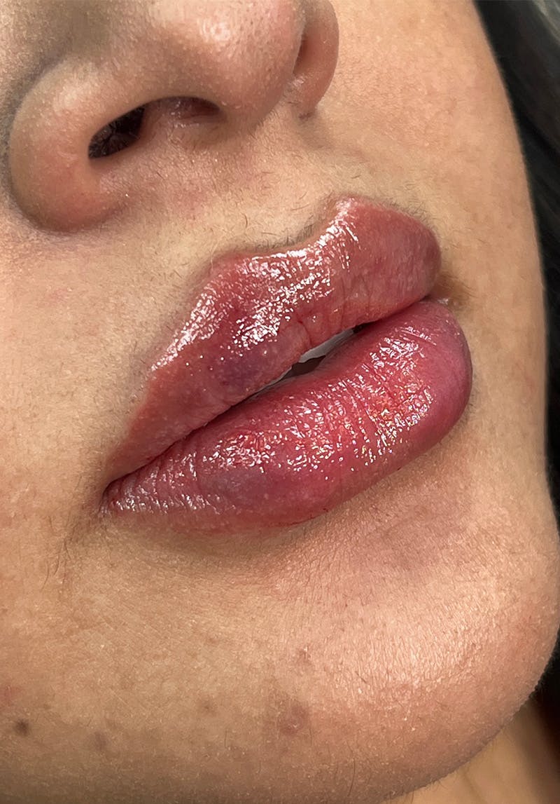 Dermal Fillers Before & After Gallery - Patient 142927780 - Image 2