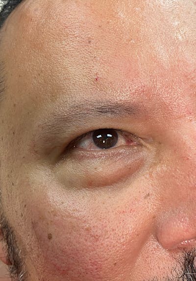 Dermal Fillers Before & After Gallery - Patient 142927779 - Image 1