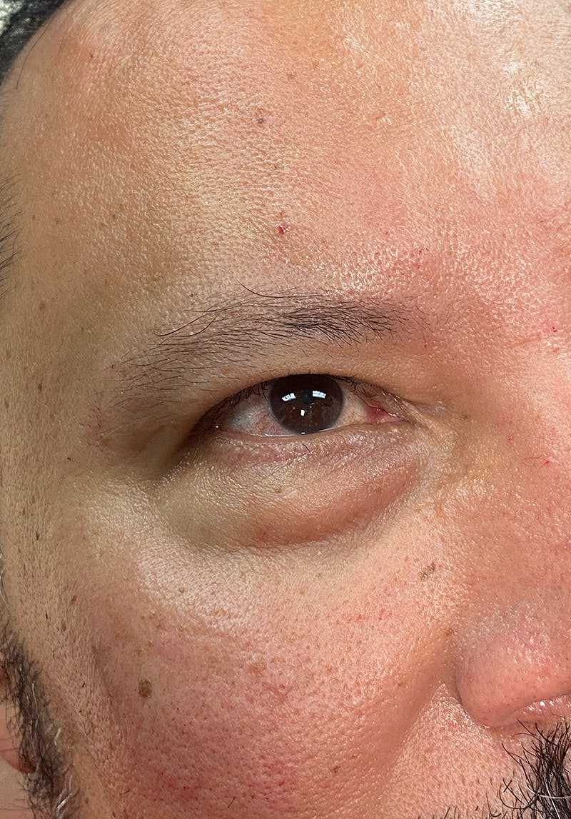 Dermal Fillers Before & After Gallery - Patient 142927779 - Image 1
