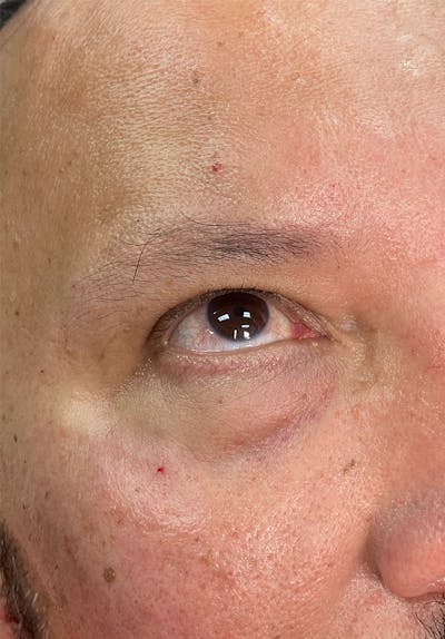 Dermal Fillers Before & After Gallery - Patient 142927779 - Image 2