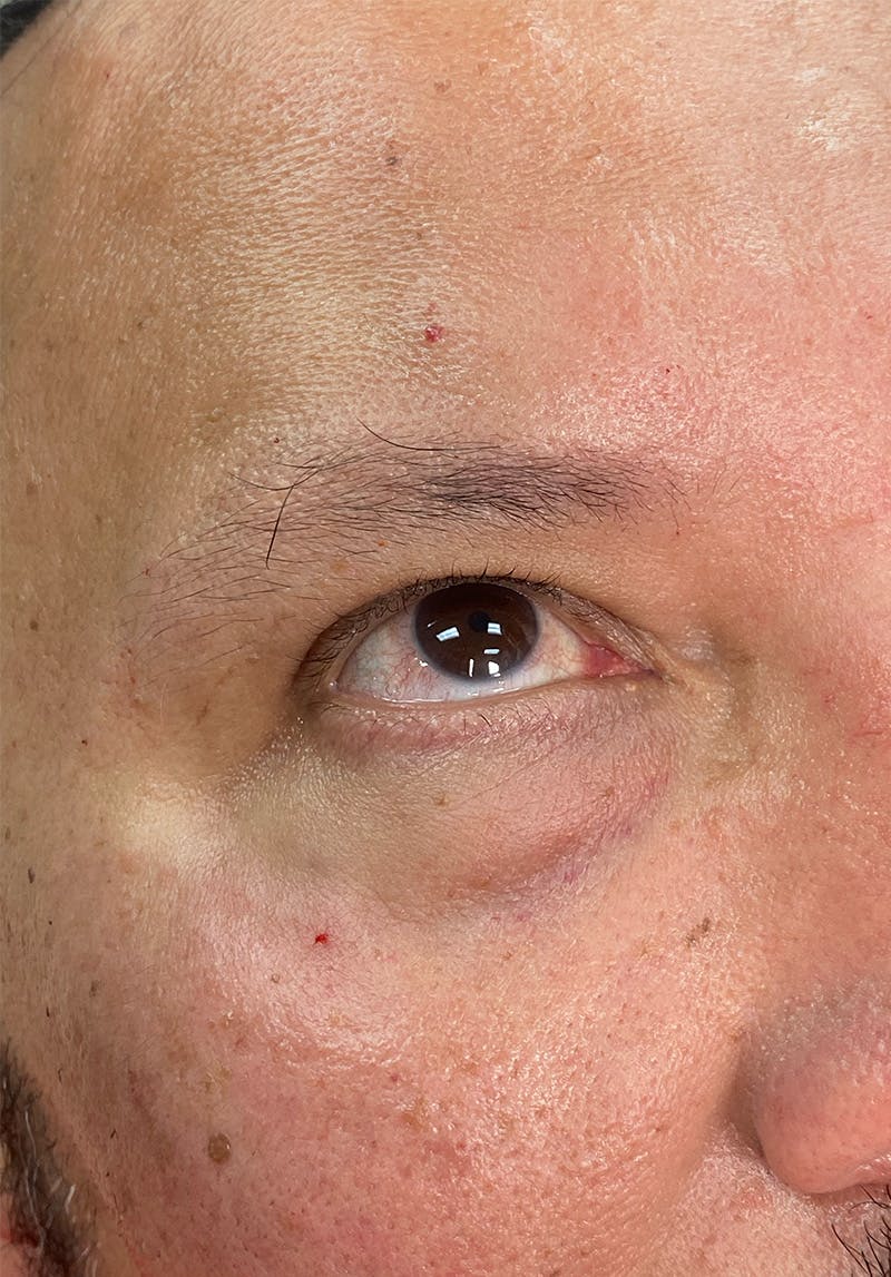 Dermal Fillers Before & After Gallery - Patient 142927779 - Image 2