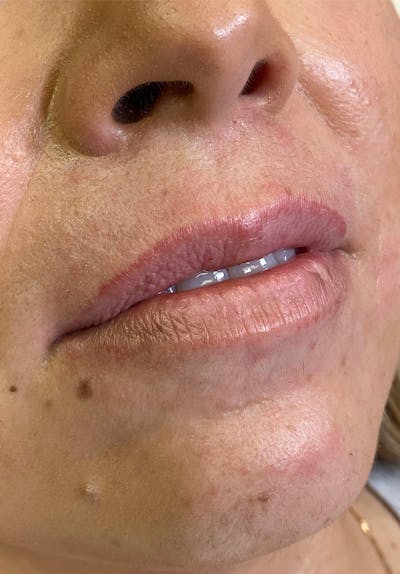 Dermal Fillers Before & After Gallery - Patient 142927778 - Image 1