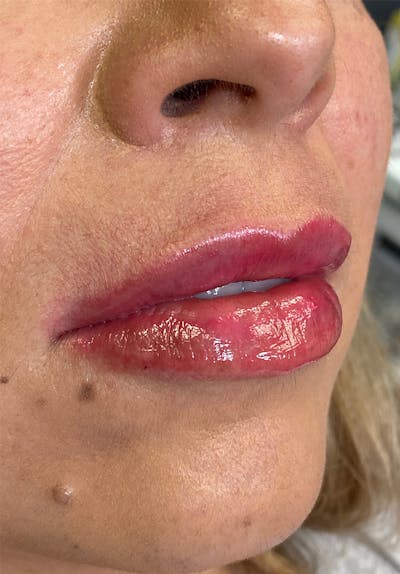 Dermal Fillers Before & After Gallery - Patient 142927778 - Image 2