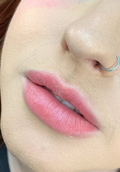 Dermal Fillers Before & After Gallery - Patient 142927777 - Image 1