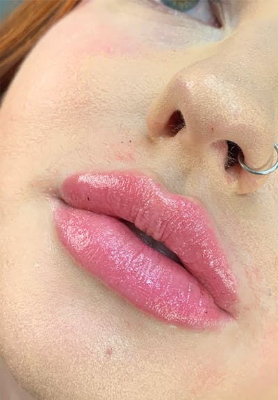 Dermal Fillers Before & After Gallery - Patient 142927777 - Image 2