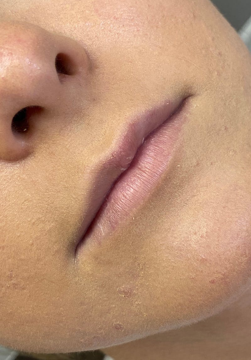 Dermal Fillers Before & After Gallery - Patient 142927776 - Image 1
