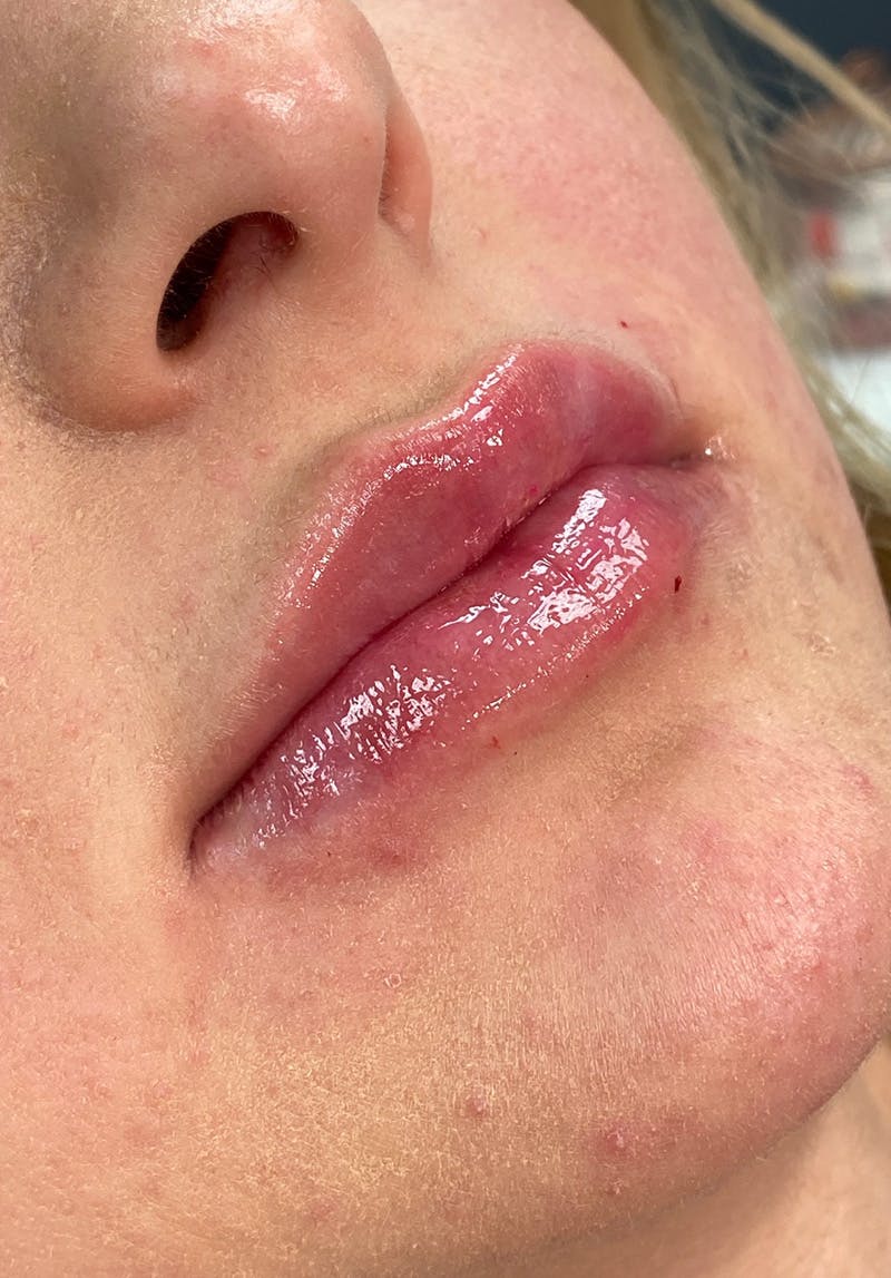 Dermal Fillers Before & After Gallery - Patient 142927776 - Image 2