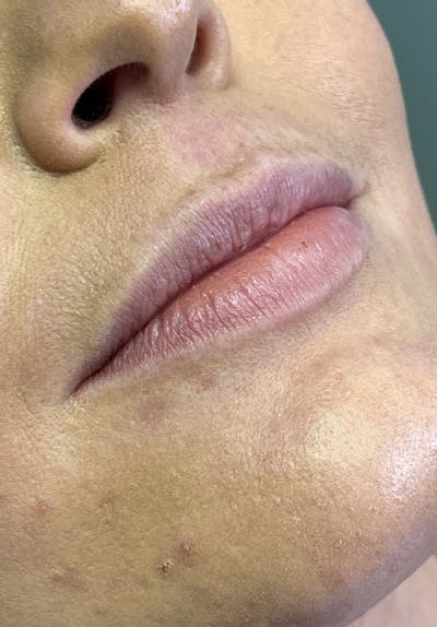 Dermal Fillers Before & After Gallery - Patient 142927775 - Image 1
