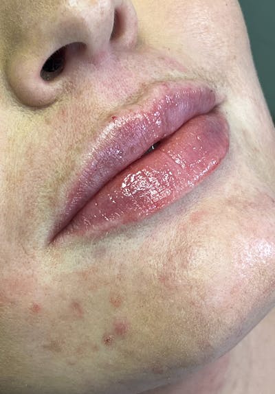 Dermal Fillers Before & After Gallery - Patient 142927775 - Image 2