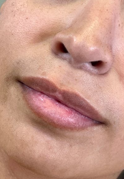 Dermal Fillers Before & After Gallery - Patient 142927774 - Image 1