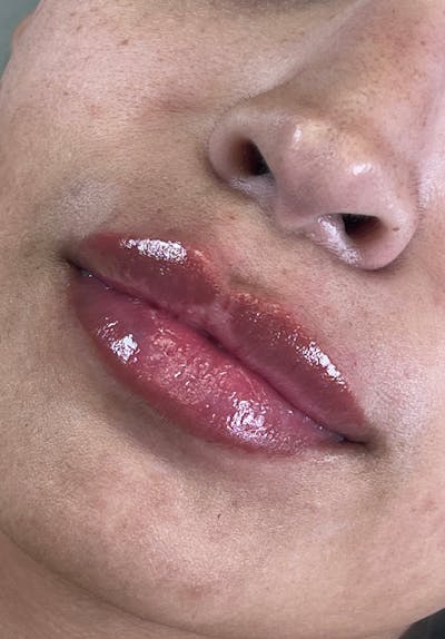 Dermal Fillers Before & After Gallery - Patient 142927774 - Image 2