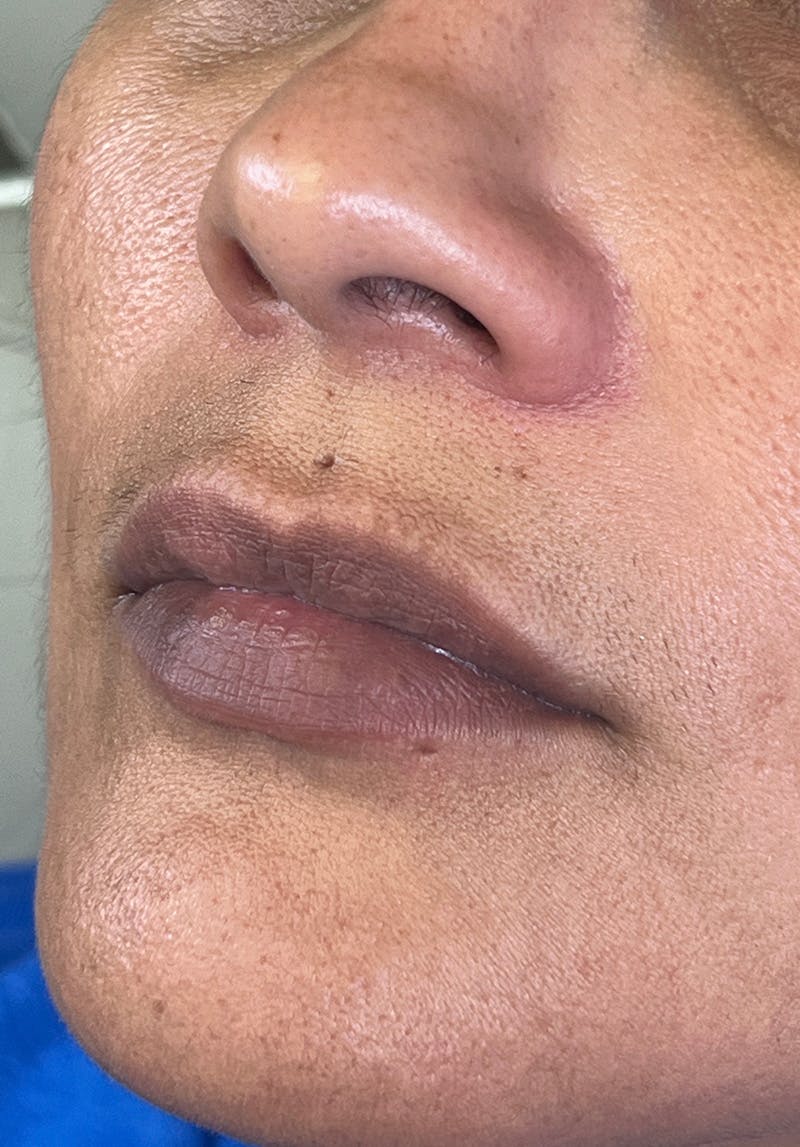 Dermal Fillers Before & After Gallery - Patient 142927773 - Image 1