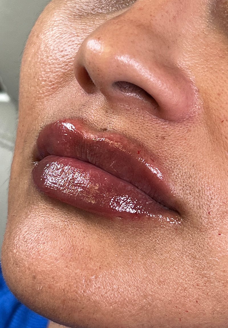 Dermal Fillers Before & After Gallery - Patient 142927773 - Image 2