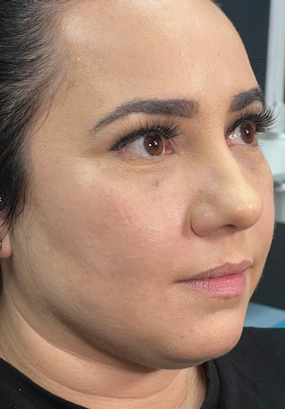 Dermal Fillers Before & After Gallery - Patient 142927772 - Image 1