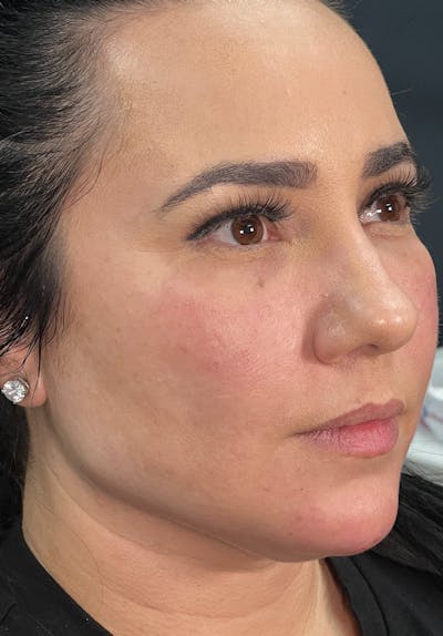 Dermal Fillers Before & After Gallery - Patient 142927772 - Image 2