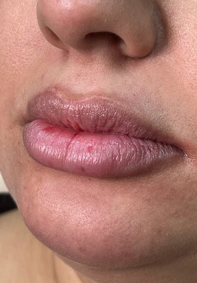Dermal Fillers Before & After Gallery - Patient 142927771 - Image 1