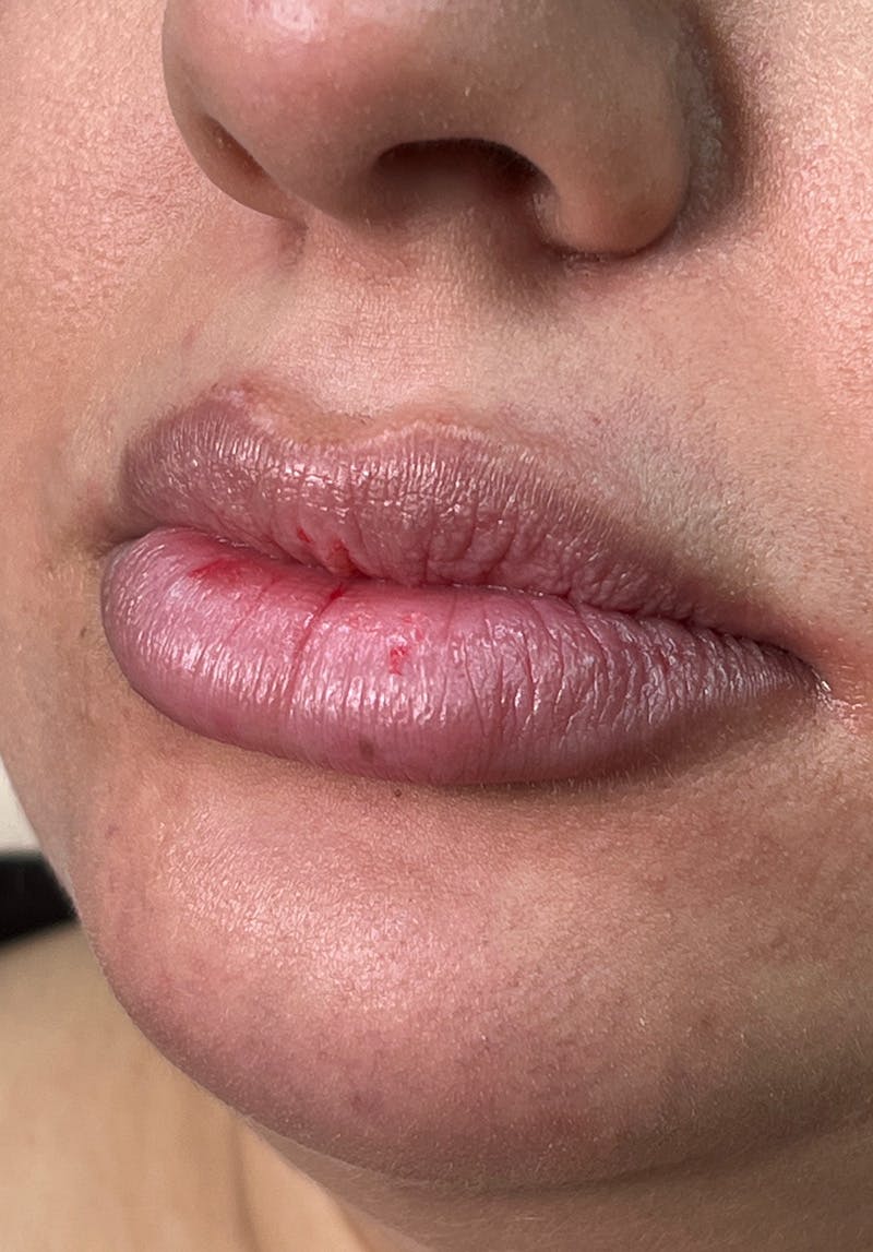 Dermal Fillers Before & After Gallery - Patient 142927771 - Image 1