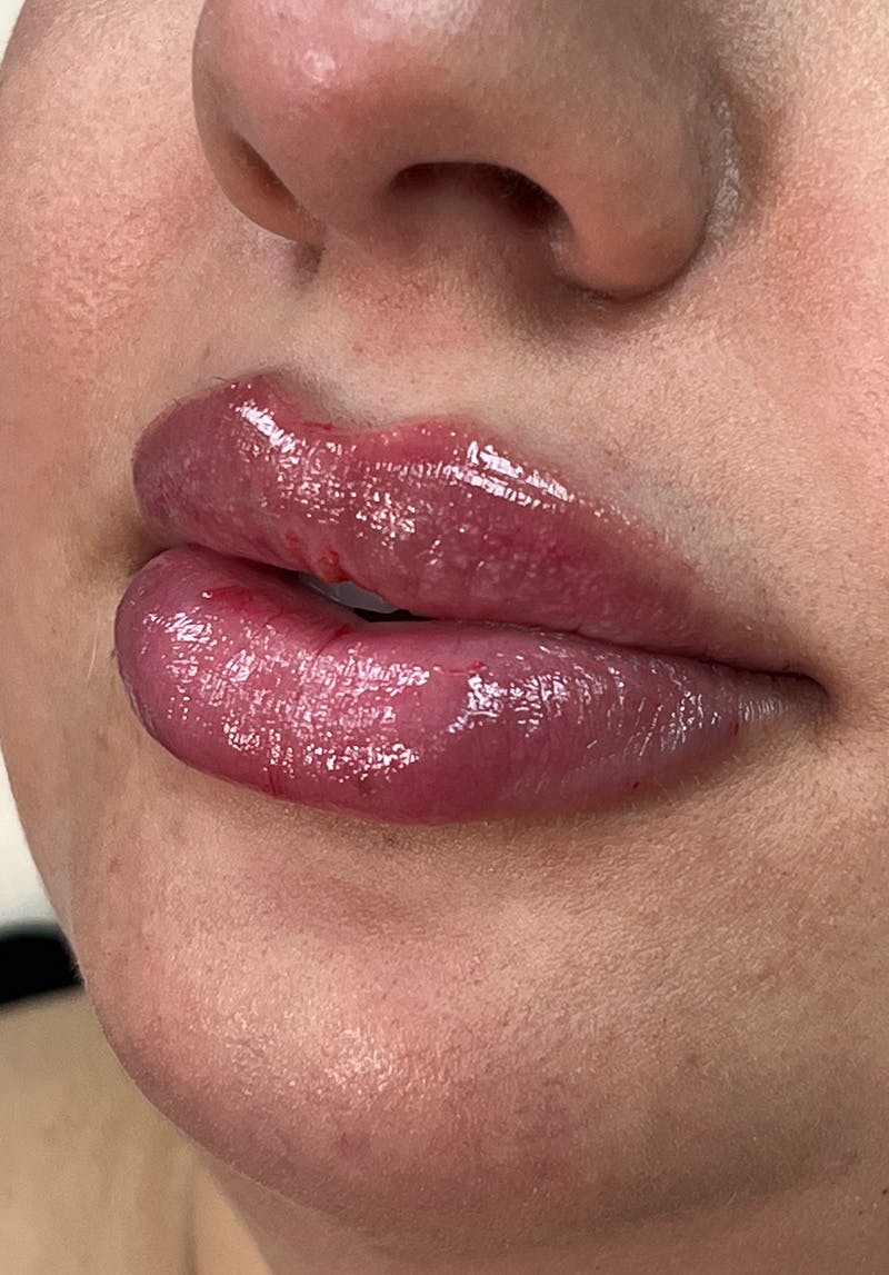 Dermal Fillers Before & After Gallery - Patient 142927771 - Image 2