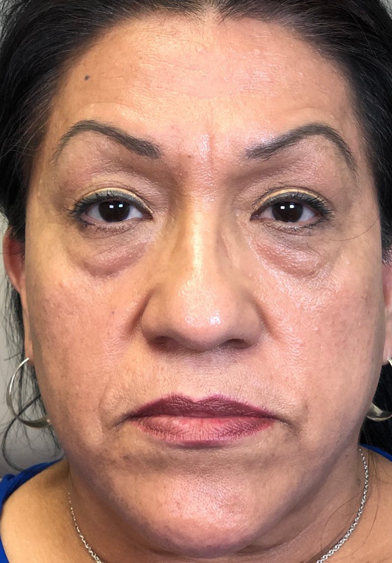 Dermal Fillers Before & After Gallery - Patient 142927770 - Image 1