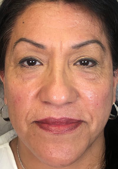 Dermal Fillers Before & After Gallery - Patient 142927770 - Image 2