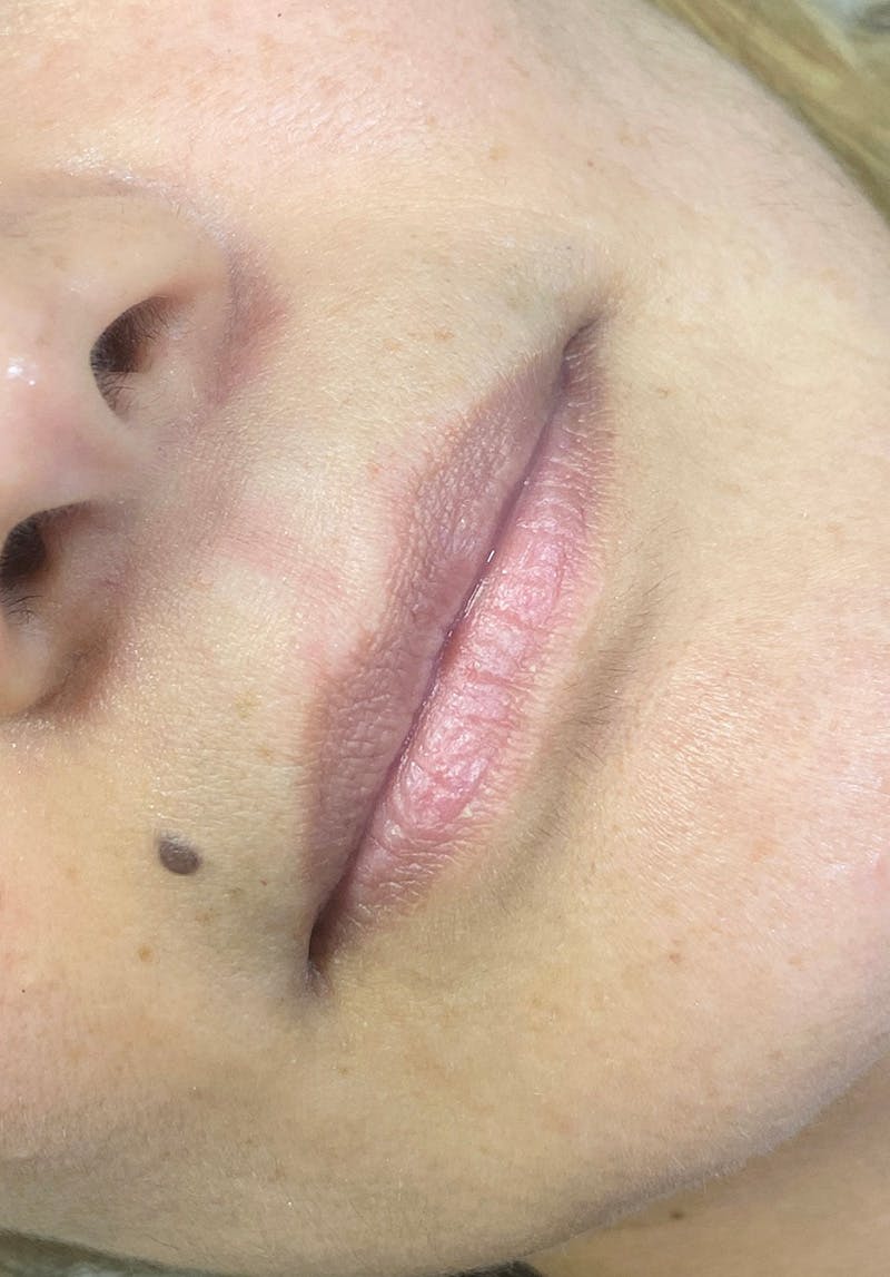 Dermal Fillers Before & After Gallery - Patient 142927768 - Image 1