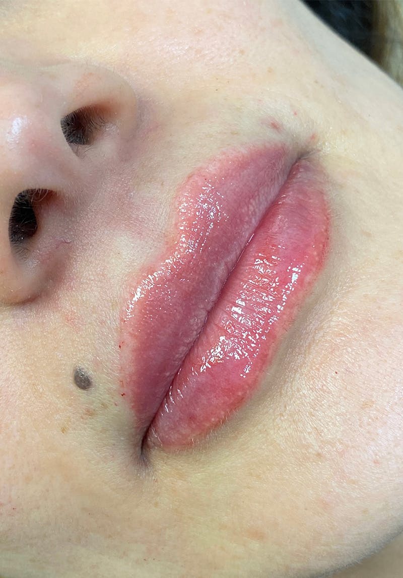 Dermal Fillers Before & After Gallery - Patient 142927768 - Image 2