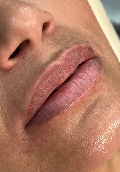 Dermal Fillers Before & After Gallery - Patient 142927769 - Image 1