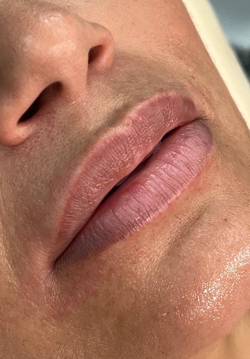 Dermal Fillers Before & After Gallery - Patient 142927769 - Image 1