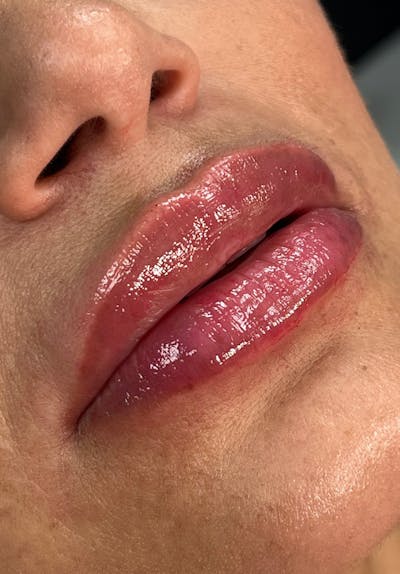 Dermal Fillers Before & After Gallery - Patient 142927769 - Image 2