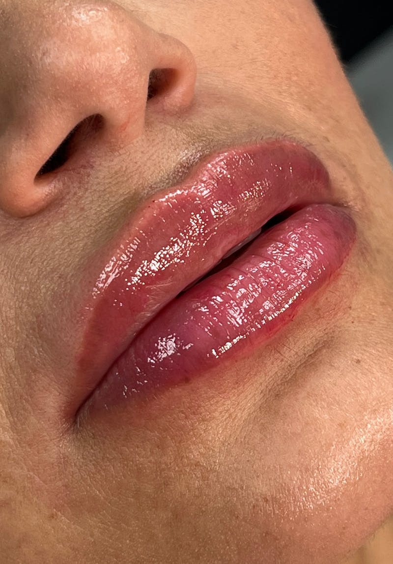 Dermal Fillers Before & After Gallery - Patient 142927769 - Image 2