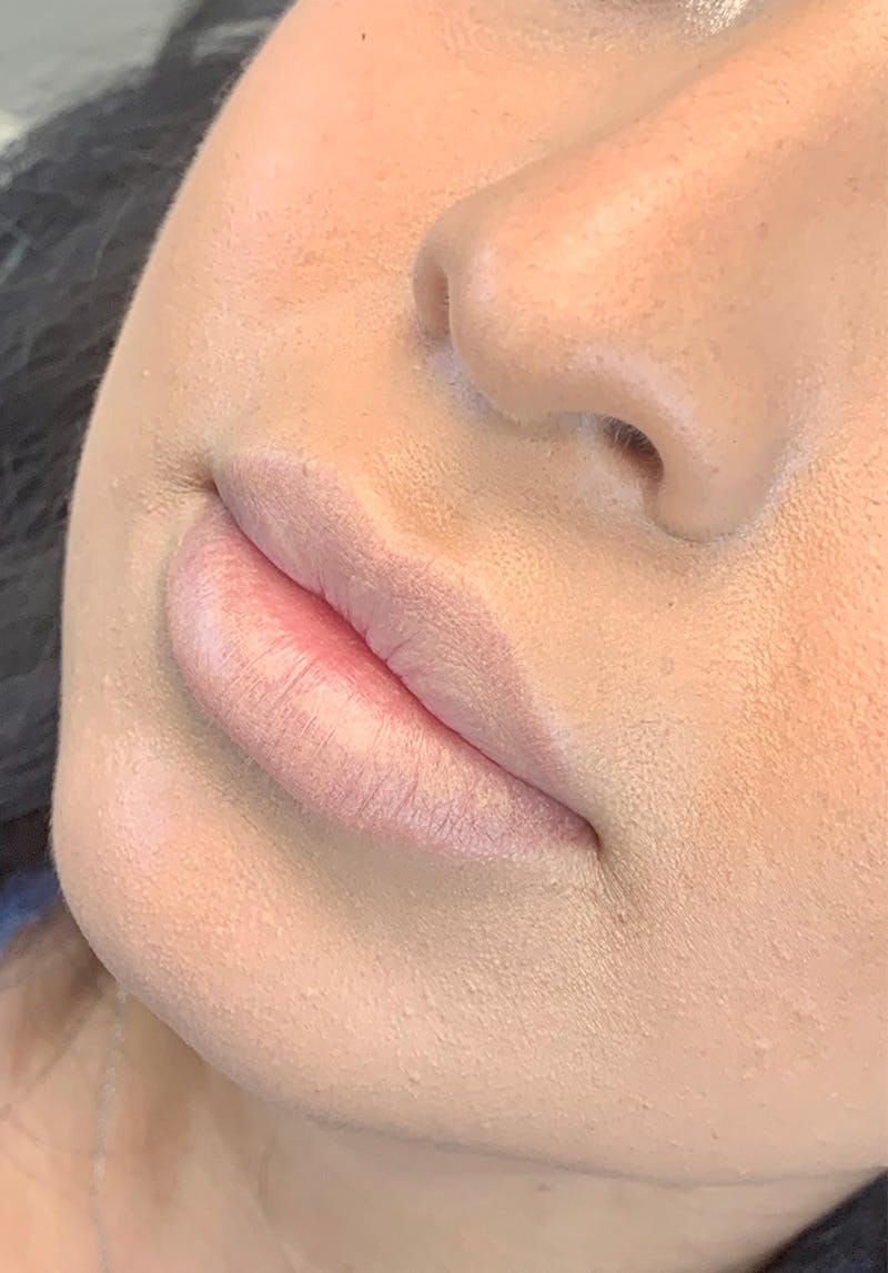 Dermal Fillers Before & After Gallery - Patient 142927767 - Image 1