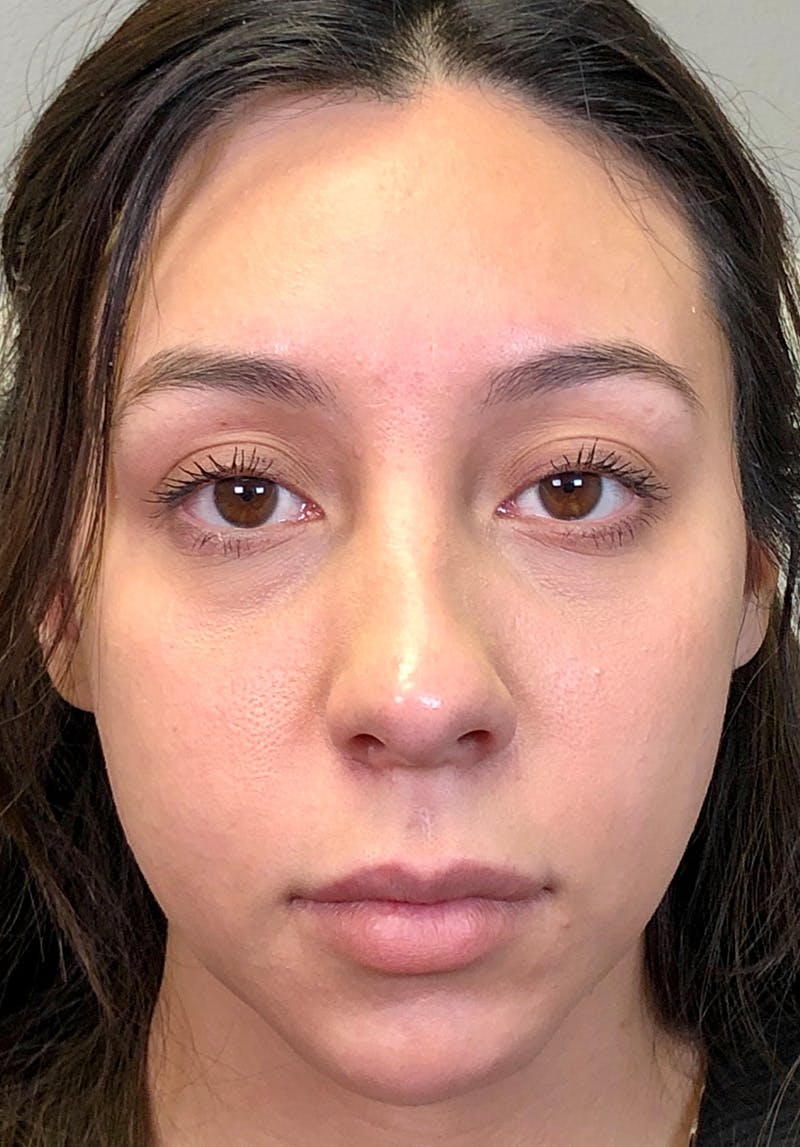 Dermal Fillers Before & After Gallery - Patient 142927766 - Image 1