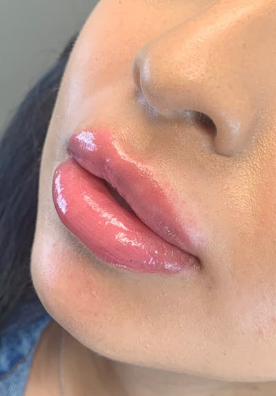 Dermal Fillers Before & After Gallery - Patient 142927767 - Image 2