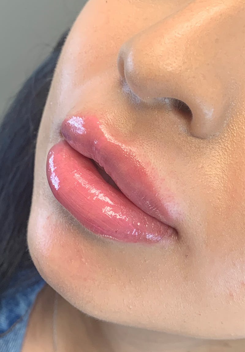 Dermal Fillers Before & After Gallery - Patient 142927767 - Image 2