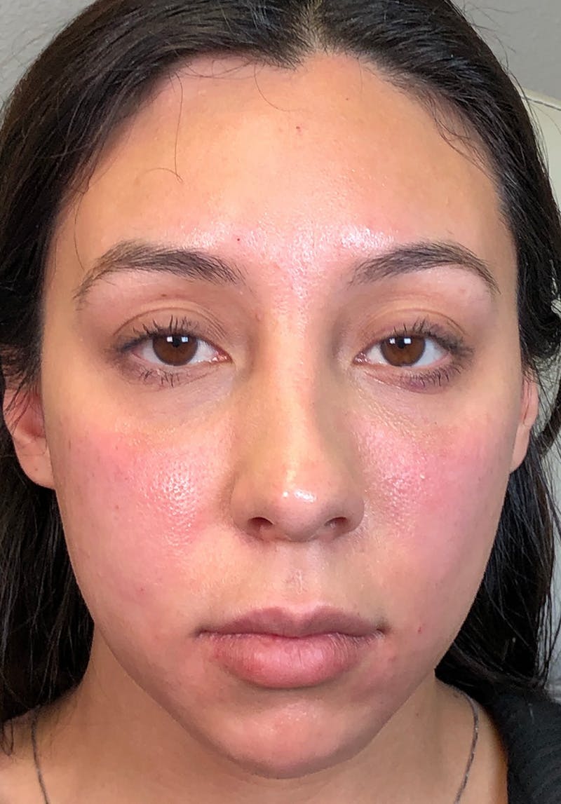 Dermal Fillers Before & After Gallery - Patient 142927766 - Image 2