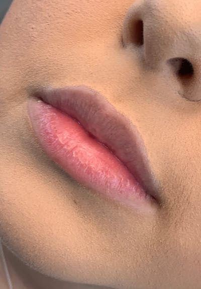 Dermal Fillers Before & After Gallery - Patient 142927765 - Image 1