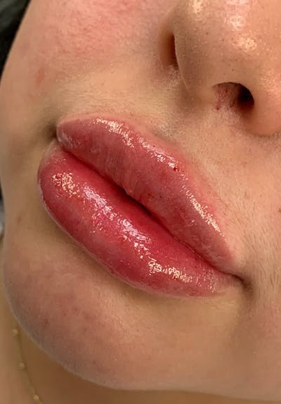 Dermal Fillers Before & After Gallery - Patient 142927765 - Image 2