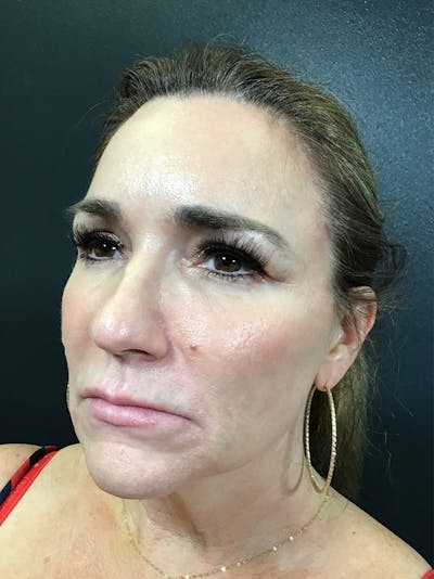 Threads Before & After Gallery - Patient 142942443 - Image 1
