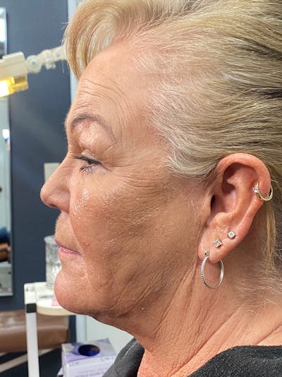 Threads Before & After Gallery - Patient 142942442 - Image 1