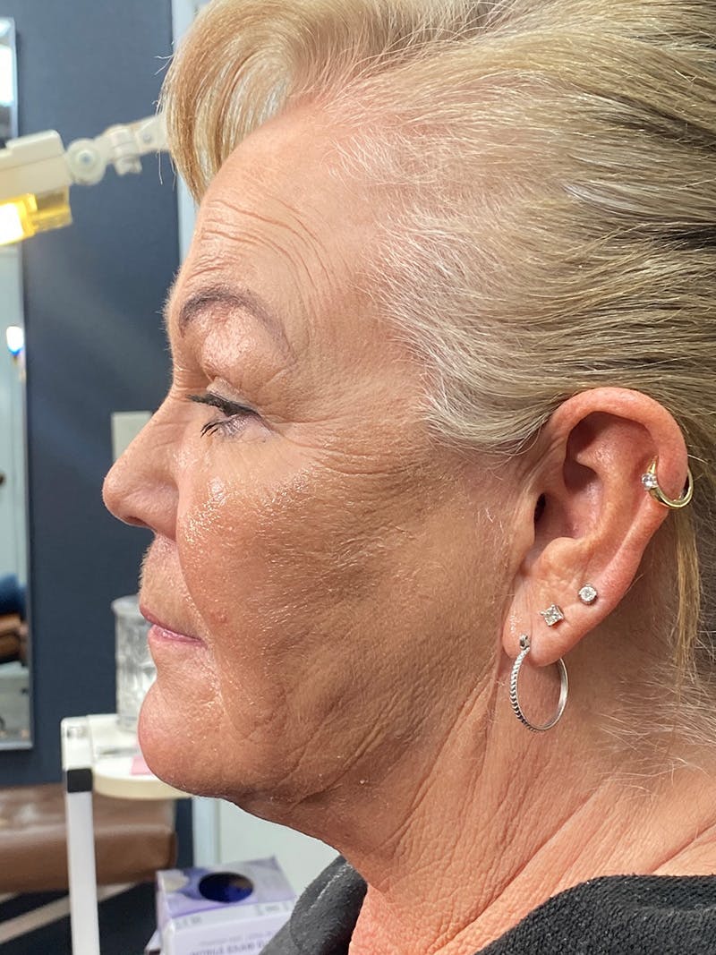 Threads Before & After Gallery - Patient 142942442 - Image 1