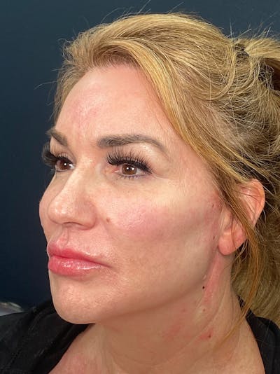Threads Before & After Gallery - Patient 142942443 - Image 2