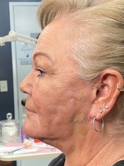 Threads Before & After Gallery - Patient 142942442 - Image 2