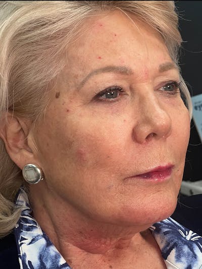 Threads Before & After Gallery - Patient 142942441 - Image 2